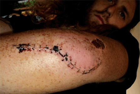 Elbow Surgery Elbow Surgery
