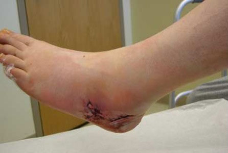 Foot Surgery Foot Surgery
