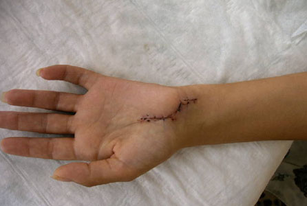 Hand Surgery