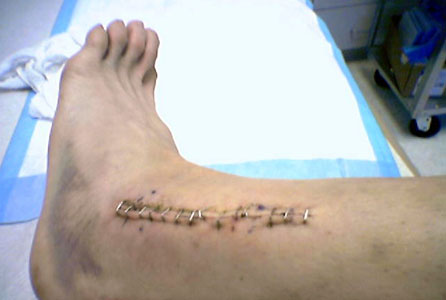 Lower Leg Surgery Lower Leg Surgery