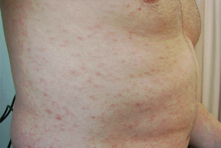 Rash Diagnosis Online