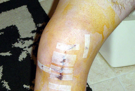 Upper Leg Surgery