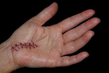 Wrist Surgery Wrist Surgery