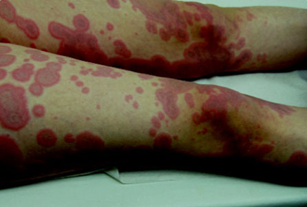 Dermatology Diagnosis Online